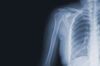 X-ray of shoulder, ribs, and spine