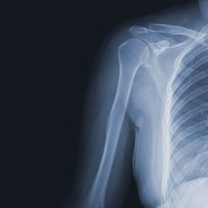 X-ray of shoulder, ribs, and spine